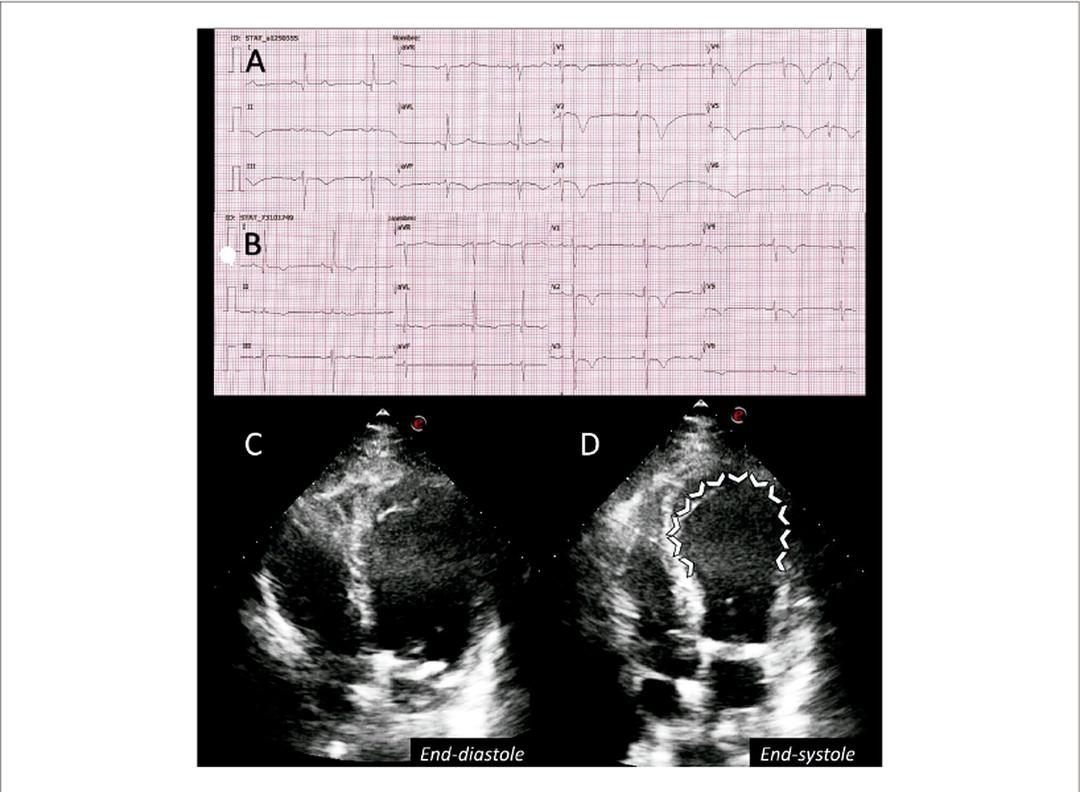 Takotsubo Syndrome in a Critical COVID-19 Patient: Electrocardiographic and Echocardiographic Evolution